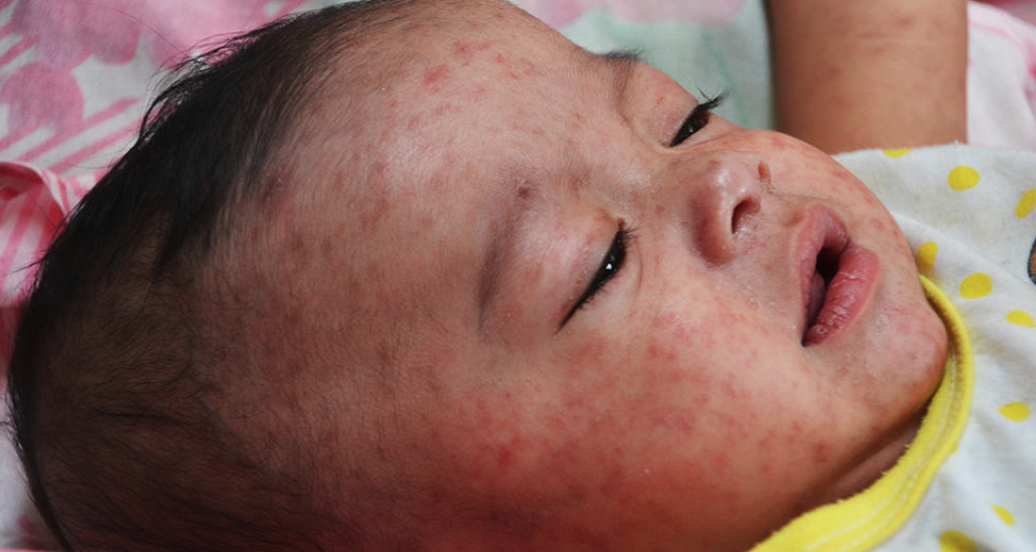Image of a baby with measles.